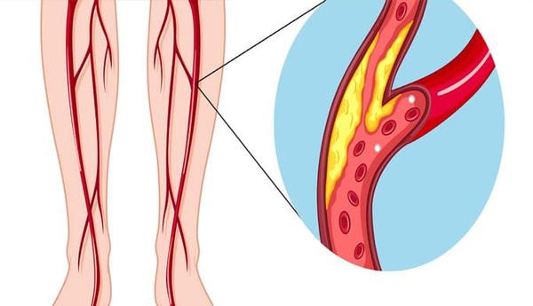 Peripheral Artery Disease (PAD) Testing